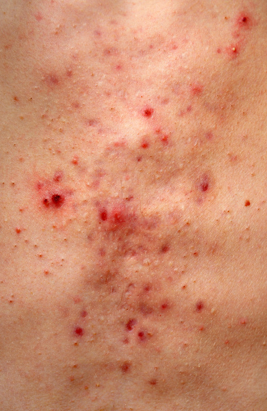 Quadriderm+Crema+Para+Que+Sirve Gelmicin Crema puede ayudar para una multitud de problemas de la piel ...