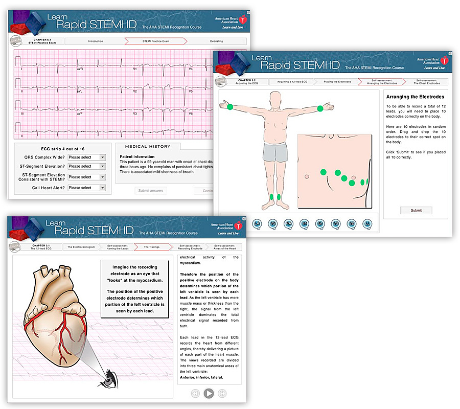 stemi2.jpg stemi2.jpg