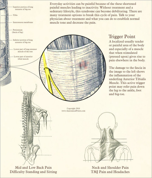 Myofascial Pain Syndrome Poster - Clinical Charts And Supplies