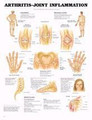 Arthritis / Joint Chart 20 w X 26 h