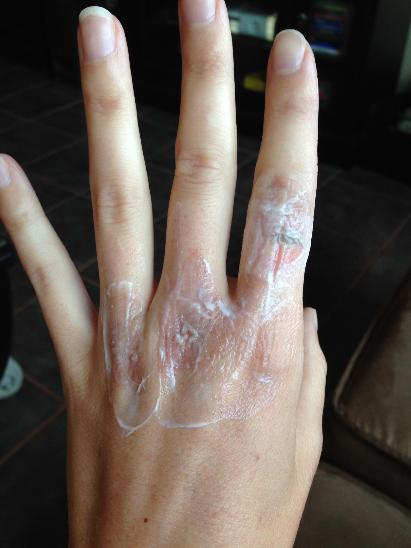 chemical burn on hands