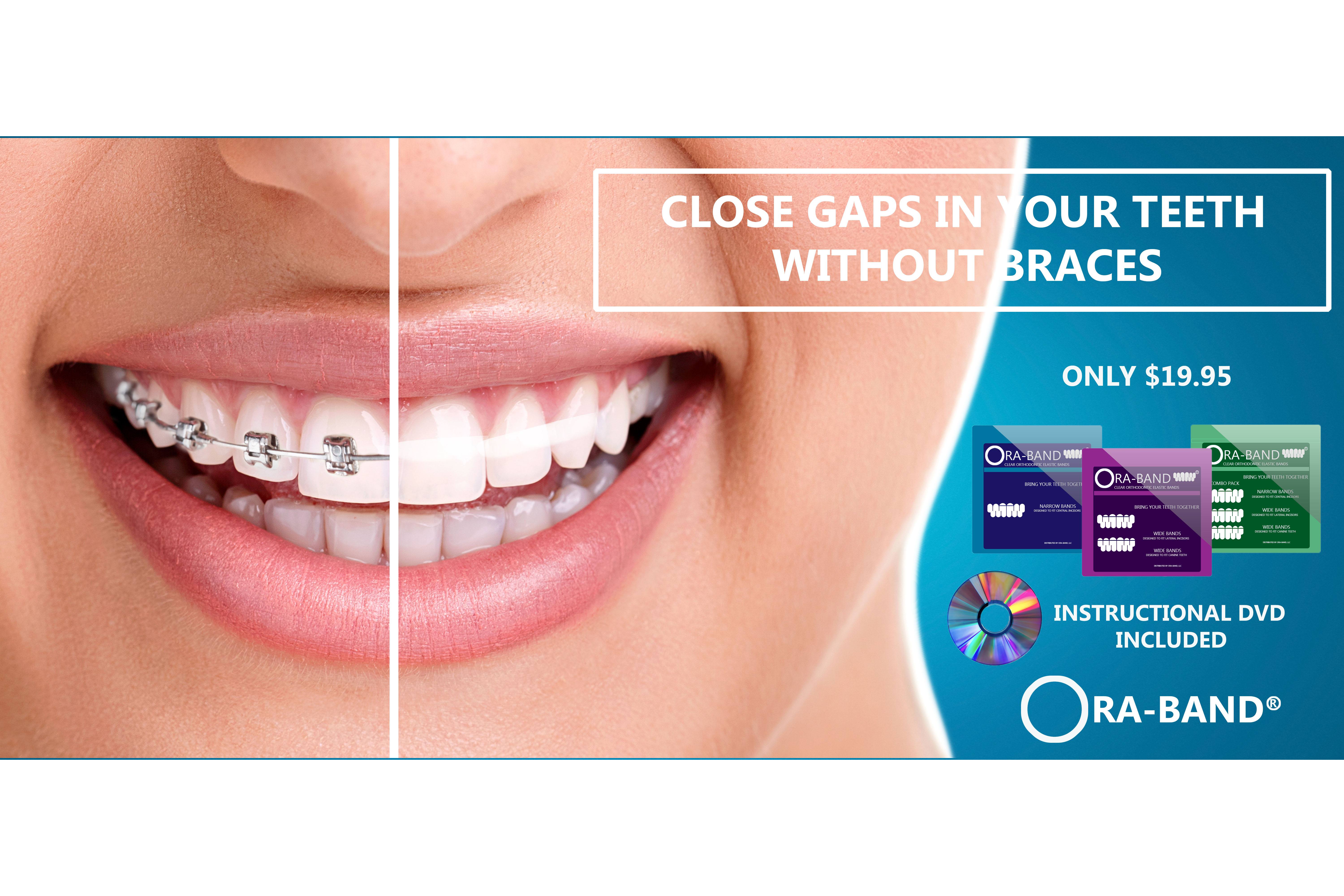 teeth fix gaps without band gap braces close elastics ora