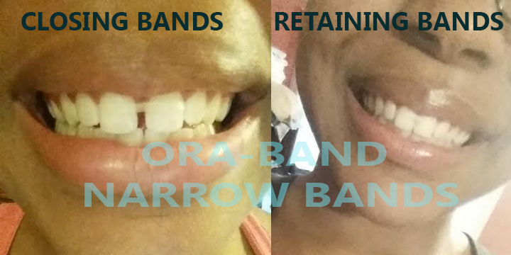orthodontic elastic gap teeth bands