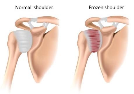 frozenshoulder.jpg