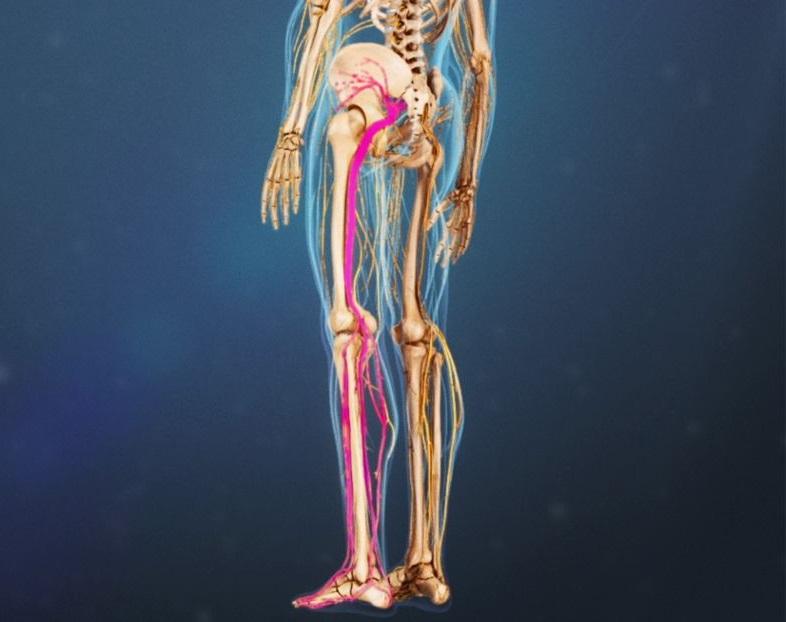 sciatica.jpg