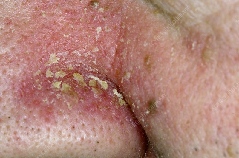 Seborrheic Dermatitis Nose