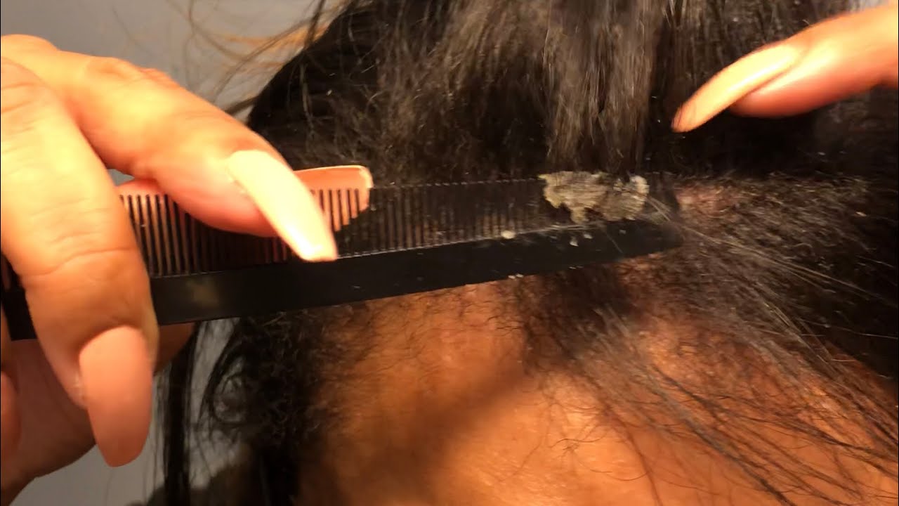 Top 8 scalp peeling off in chunks 1 What Can I Do About My Scalp Peeling Off In Chunks