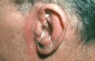 Seborheic Dematitis Ears Crusty Dandruff
