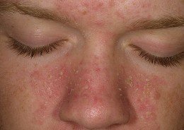 Seborrheic Dermatitis Face With Flakes and Redness