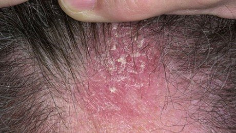 Seborrheic Dermatitis Flaking On Scalp