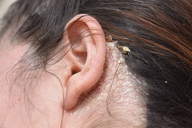 Seborrhea Dandruff Ears Back of Scalp