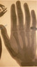 Left hand of a man with a ring on his finger and a bullet in his wrist.