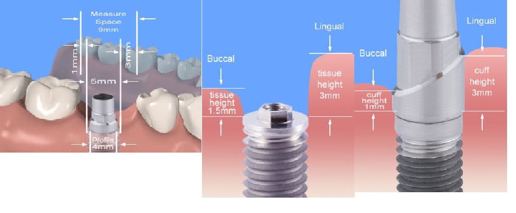 Simple Step Abutment dimension diagram showing prep heights, collar heights and emergence profile diameters