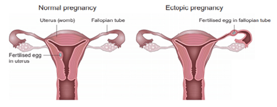 sites-of-ectopic-pregnancy-550.jpg