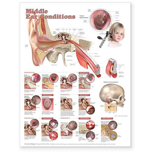 Middle Ear Conditions Anatomy Poster - Clinical Charts and Supplies
