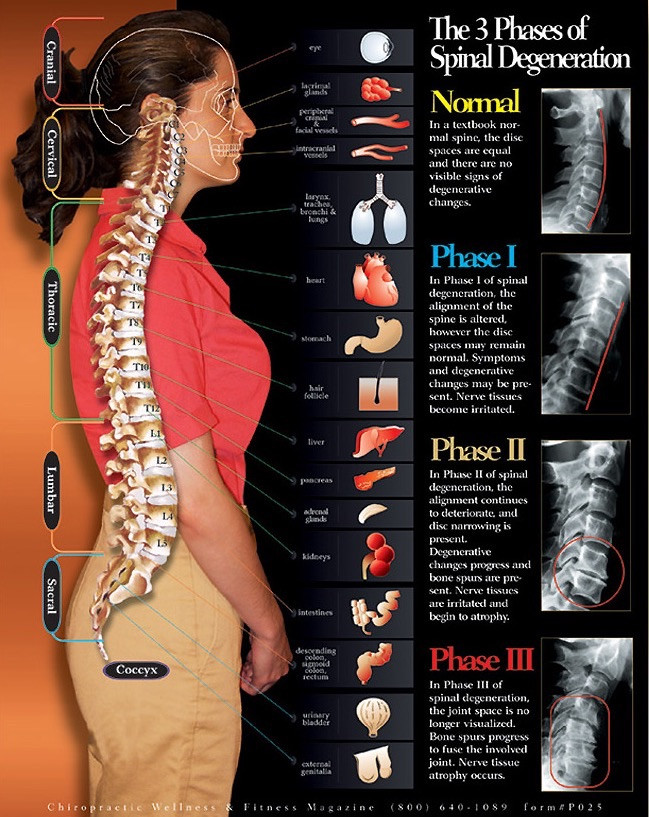 3 Phases of Spinal Degeneration Chiropractic Chart - Clinical Charts and Supplies