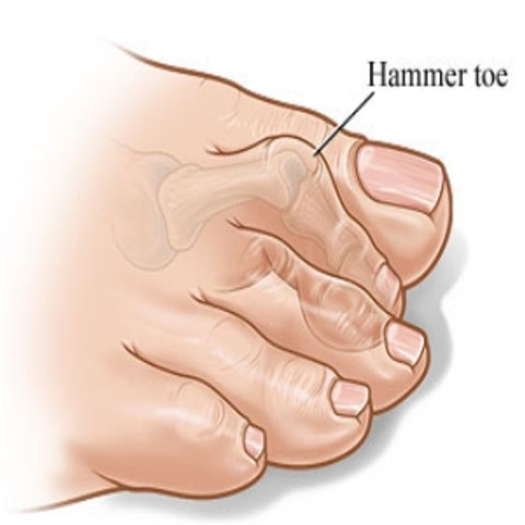 What Are Hammetoes? How Do You Fix Them?